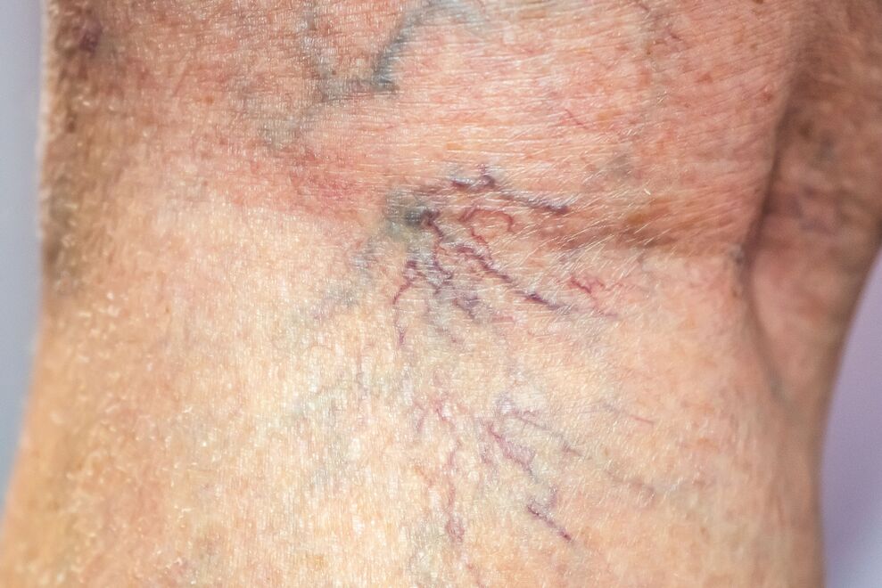 varizes veias no corpo