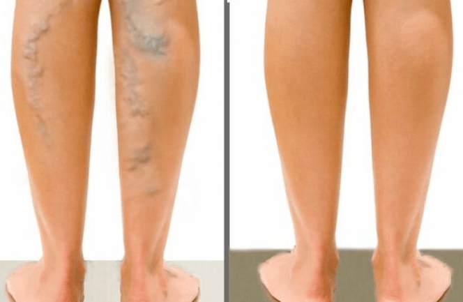 Varizes antes e depois da cirurgia
