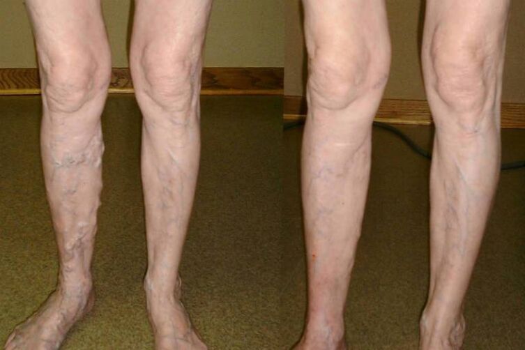 varizes veias em homens