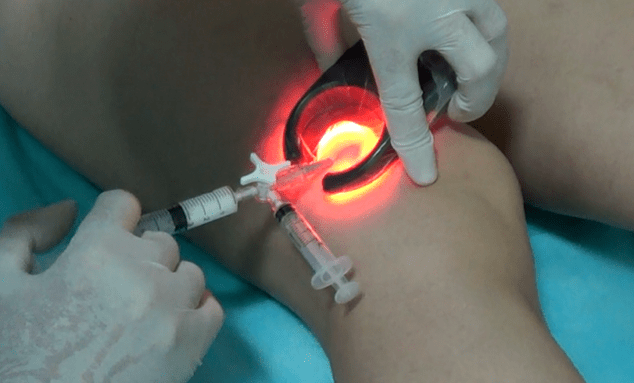 A escleroterapia é um método eficaz de tratamento de varizes nas pernas